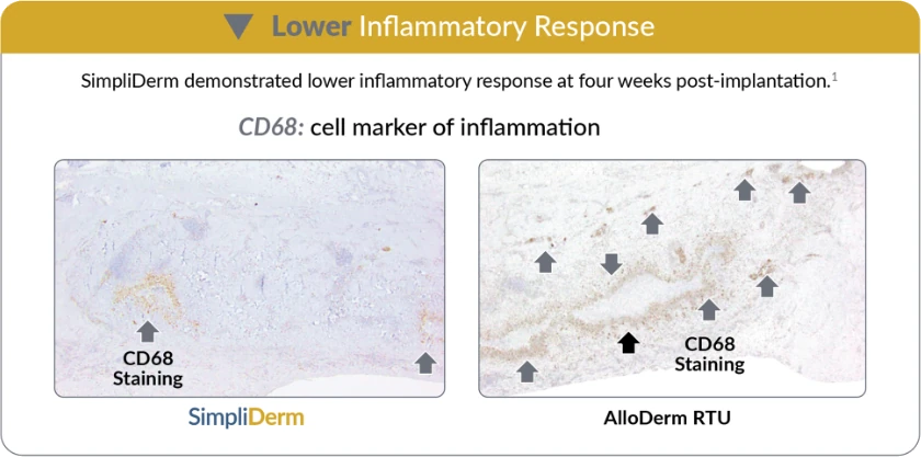 SimpliDerm ADM Lower Inflammatory Reponse Chart